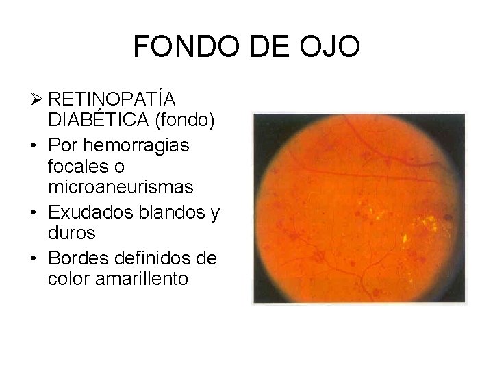 FONDO DE OJO Ø RETINOPATÍA DIABÉTICA (fondo) • Por hemorragias focales o microaneurismas •