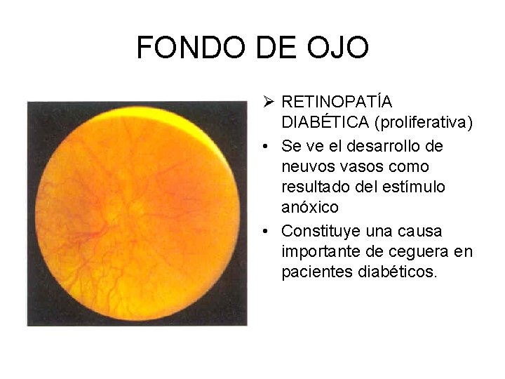 FONDO DE OJO Ø RETINOPATÍA DIABÉTICA (proliferativa) • Se ve el desarrollo de neuvos