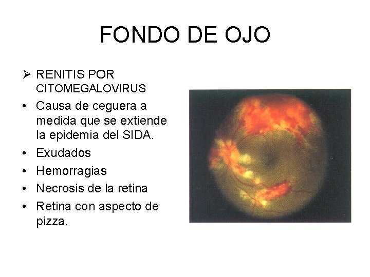 FONDO DE OJO Ø RENITIS POR CITOMEGALOVIRUS • Causa de ceguera a medida que