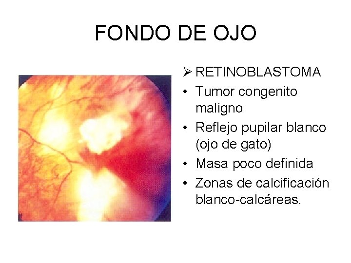 FONDO DE OJO Ø RETINOBLASTOMA • Tumor congenito maligno • Reflejo pupilar blanco (ojo