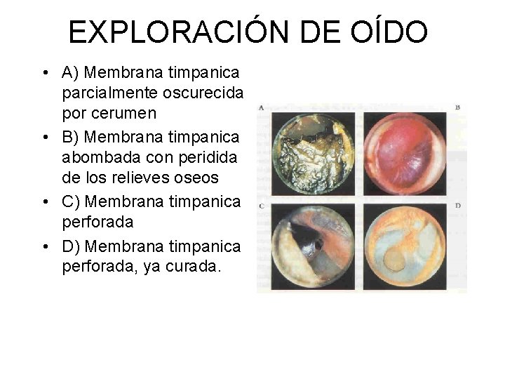 EXPLORACIÓN DE OÍDO • A) Membrana timpanica parcialmente oscurecida por cerumen • B) Membrana