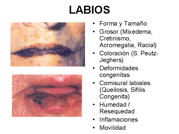 LABIOS • Forma y Tamaño • Grosor (Mixedema, Cretinismo, Acromegalia, Racial) • Coloración (S.