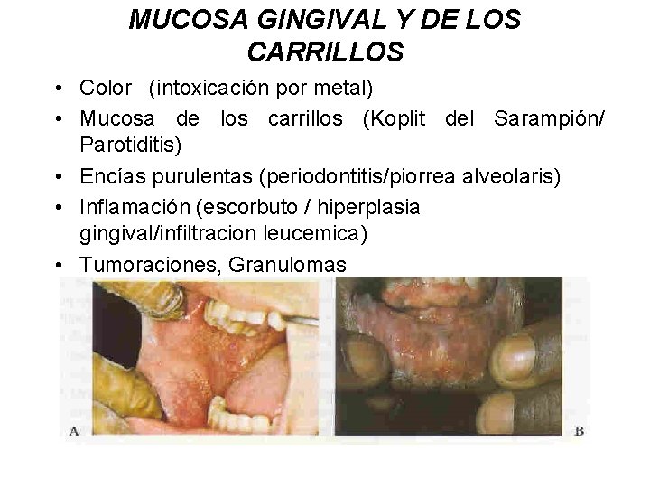 MUCOSA GINGIVAL Y DE LOS CARRILLOS • Color (intoxicación por metal) • Mucosa de