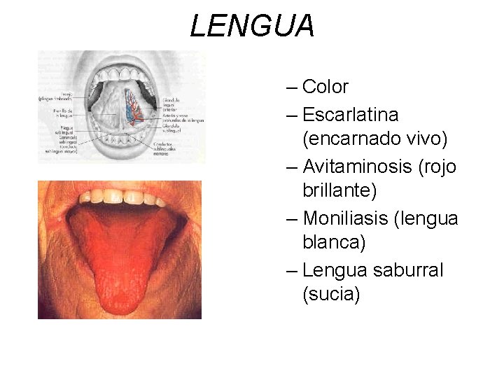 LENGUA – Color – Escarlatina (encarnado vivo) – Avitaminosis (rojo brillante) – Moniliasis (lengua