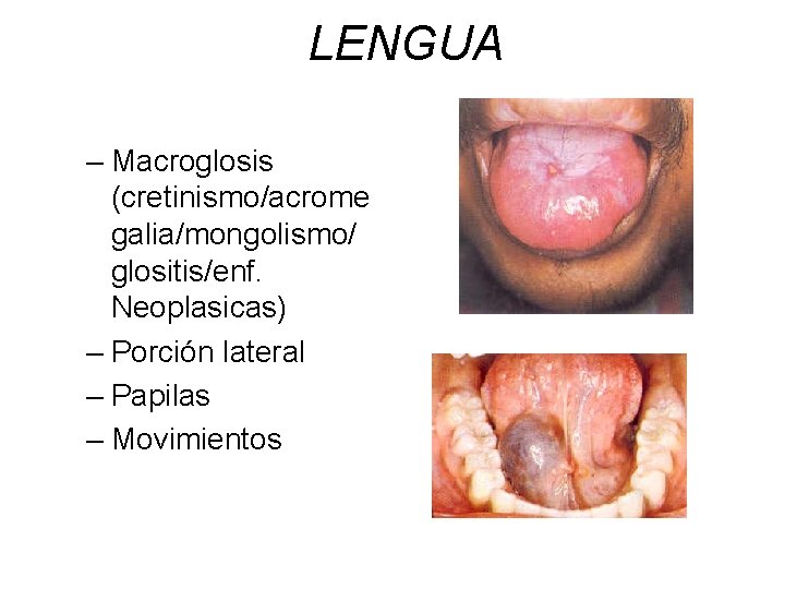 LENGUA – Macroglosis (cretinismo/acrome galia/mongolismo/ glositis/enf. Neoplasicas) – Porción lateral – Papilas – Movimientos