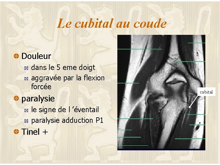 Le cubital au coude Douleur dans le 5 eme doigt aggravée par la flexion