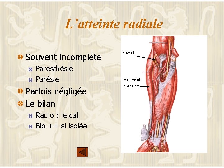 L’atteinte radiale Souvent incomplète Paresthésie Parfois négligée Le bilan Radio : le cal Bio