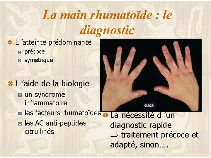 La main rhumatoïde : le diagnostic L ’atteinte prédominante précoce symétrique L ’aide de