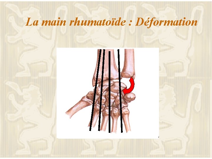 La main rhumatoïde : Déformation 