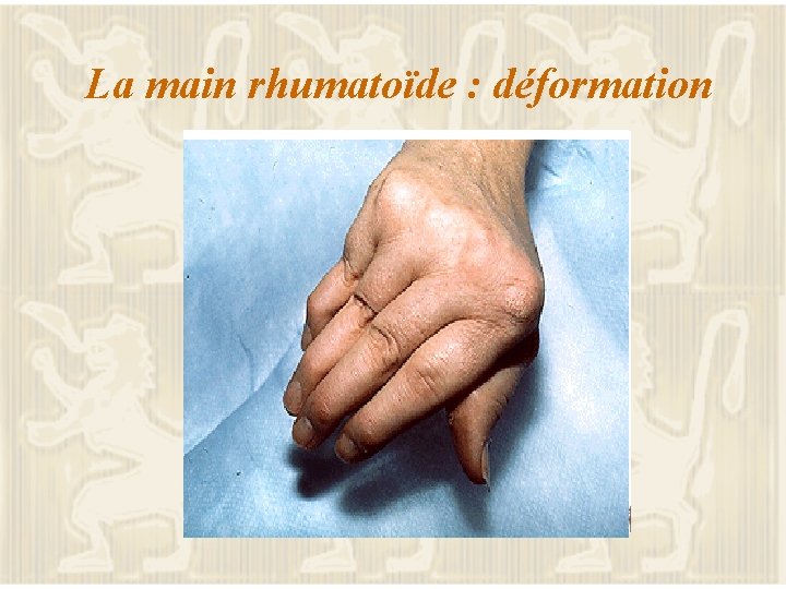 La main rhumatoïde : déformation 