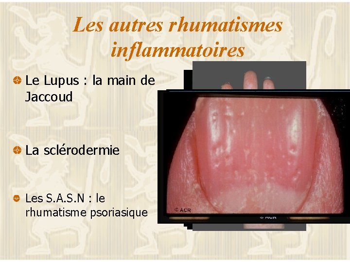 Les autres rhumatismes inflammatoires Le Lupus : la main de Jaccoud La sclérodermie Les