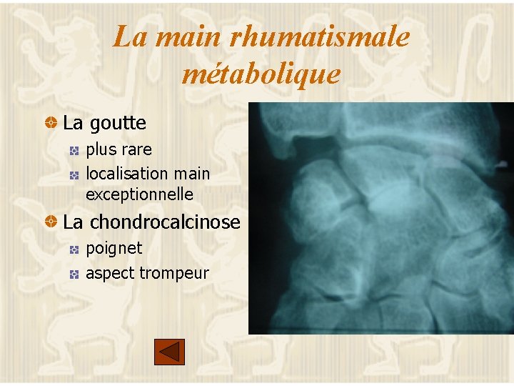 La main rhumatismale métabolique La goutte plus rare localisation main exceptionnelle La chondrocalcinose poignet