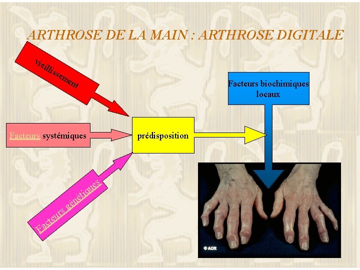 ARTHROSE DE LA MAIN : ARTHROSE DIGITALE vie illi sse m ent Facteurs biochimiques