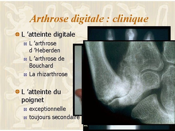 Arthrose digitale : clinique L ’atteinte digitale L ’arthrose d ’Heberden L ’arthrose de