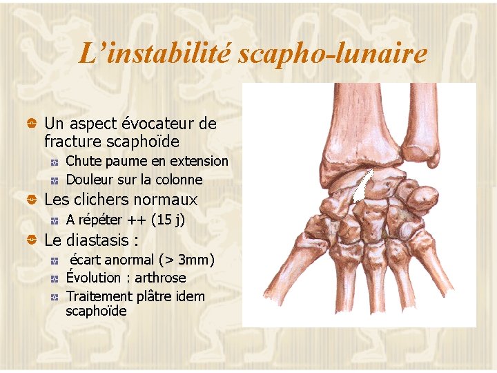 L’instabilité scapho-lunaire Un aspect évocateur de fracture scaphoïde Chute paume en extension Douleur sur
