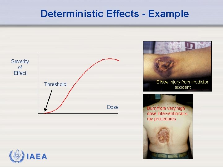 Deterministic Effects - Example Severity of Effect Elbow injury from irradiator accident Threshold Dose