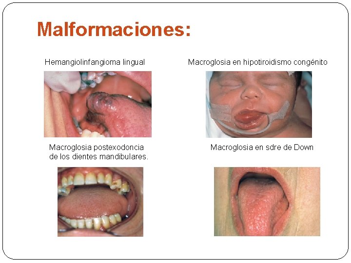 Malformaciones: Hemangiolinfangioma lingual Macroglosia postexodoncia de los dientes mandibulares. Macroglosia en hipotiroidismo congénito Macroglosia