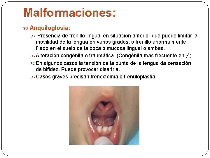 Malformaciones: Anquiloglosia: Presencia de frenillo lingual en situación anterior que puede limitar la movilidad