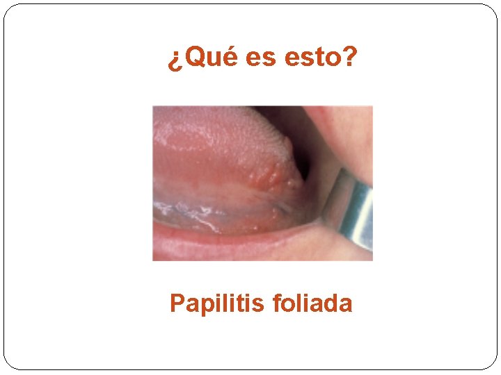 ¿Qué es esto? Papilitis foliada 