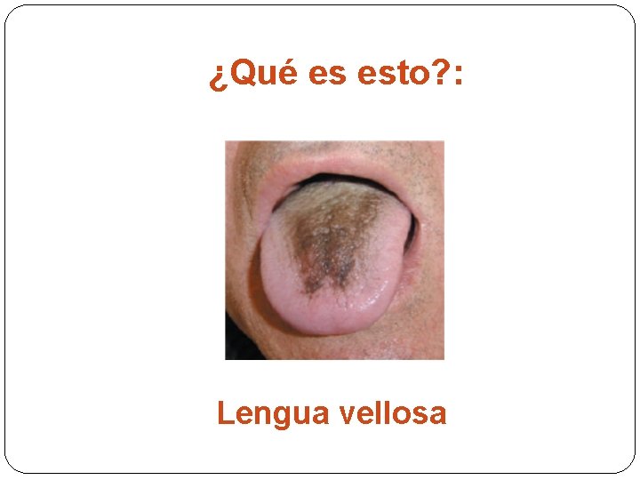 ¿Qué es esto? : Lengua vellosa 