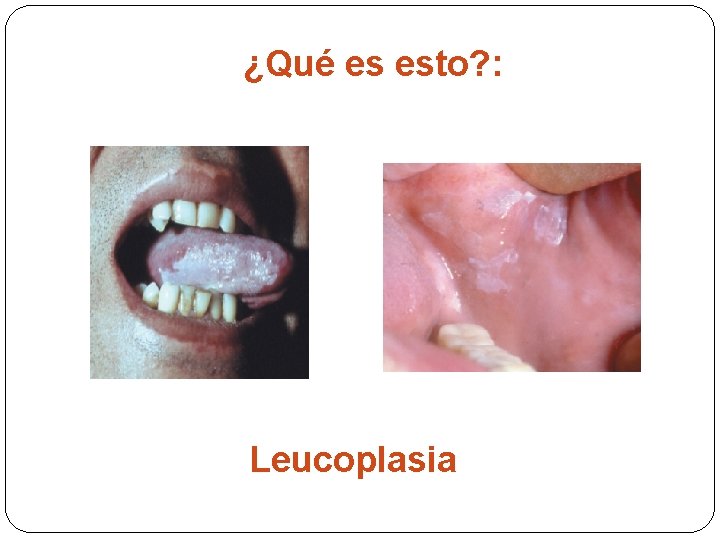 ¿Qué es esto? : Leucoplasia 
