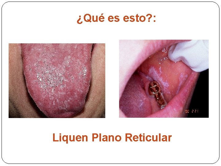 ¿Qué es esto? : Liquen Plano Reticular 