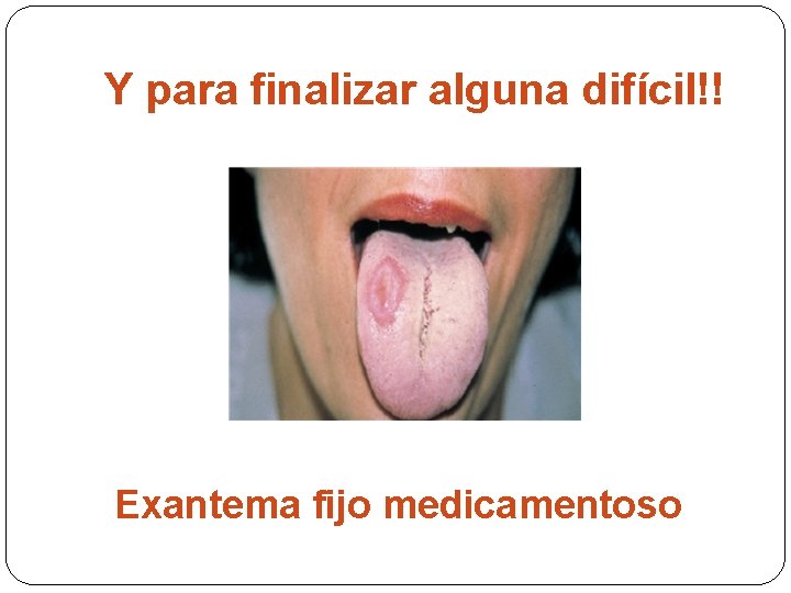 Y para finalizar alguna difícil!! Exantema fijo medicamentoso 