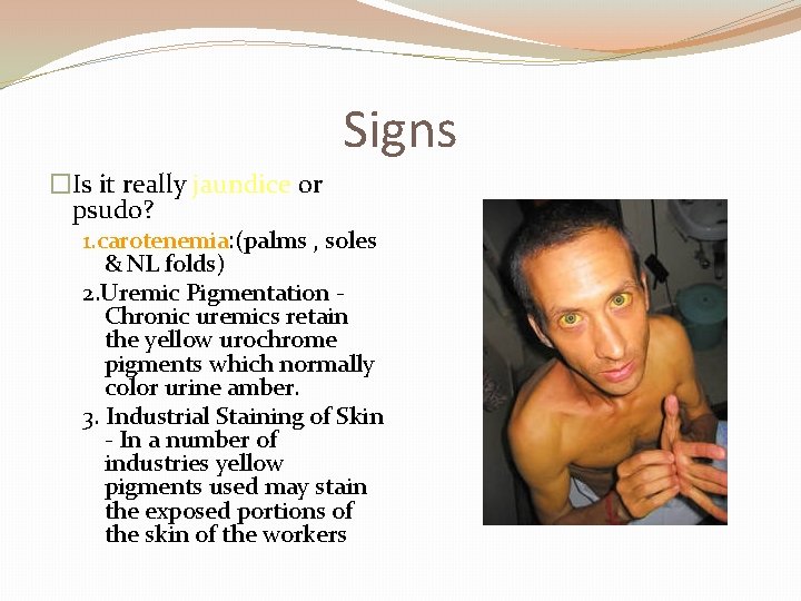 Signs �Is it really jaundice or psudo? 1. carotenemia: (palms , soles & NL