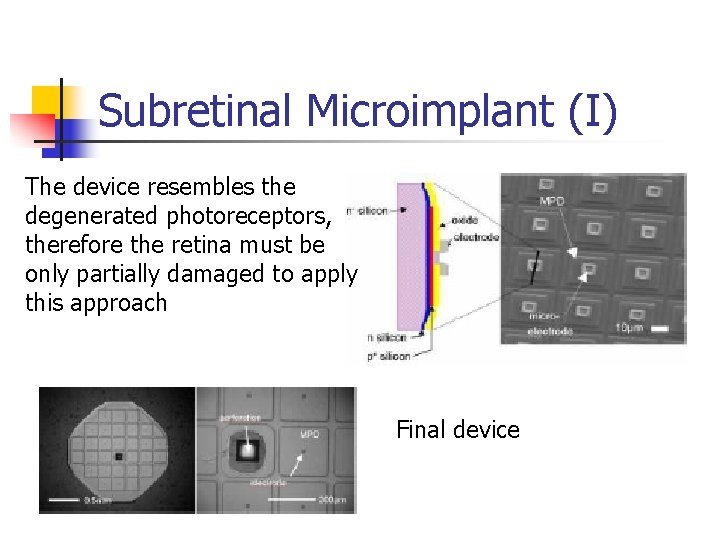 Subretinal Microimplant (I) The device resembles the degenerated photoreceptors, therefore the retina must be