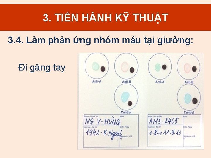 3. TIẾN HÀNH KỸ THUẬT 3. 4. Làm phản ứng nhóm máu tại giường: