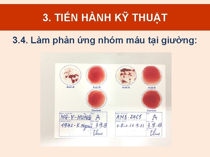 3. TIẾN HÀNH KỸ THUẬT 3. 4. Làm phản ứng nhóm máu tại giường: