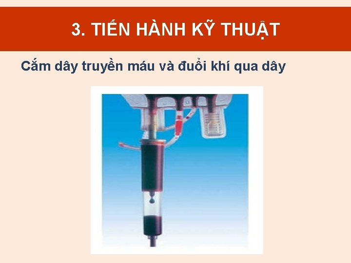 3. TIẾN HÀNH KỸ THUẬT Cắm dây truyền máu và đuổi khí qua dây
