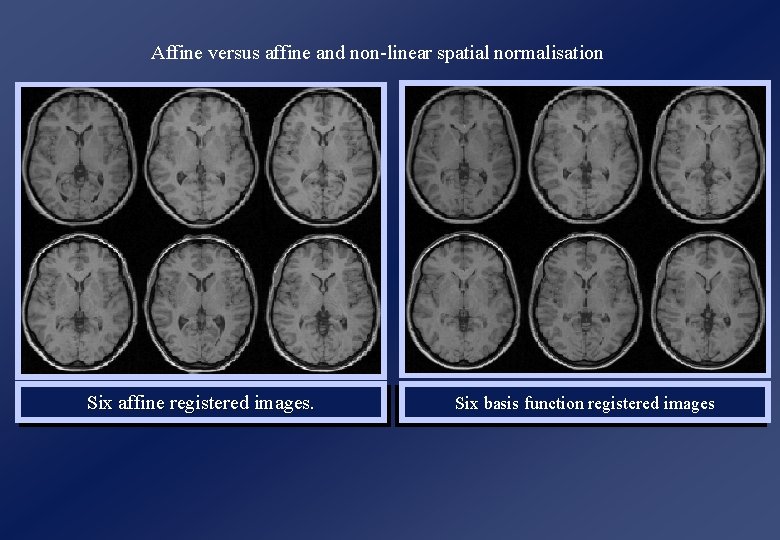 Affine versus affine and non-linear spatial normalisation Six affine registered images. Six basis function