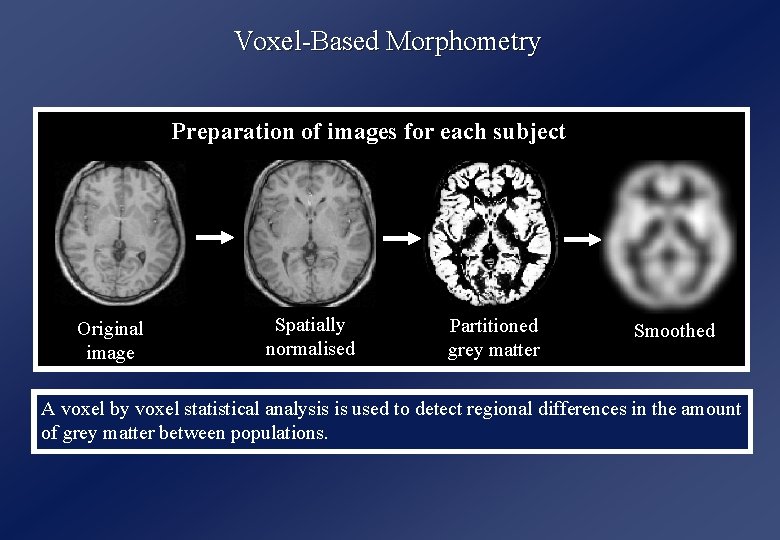 Voxel-Based Morphometry Preparation of images for each subject Original image Spatially normalised Partitioned grey