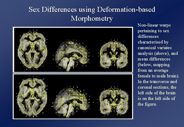 Sex Differences using Deformation-based Morphometry Non-linear warps pertaining to sex differences characterised by canonical