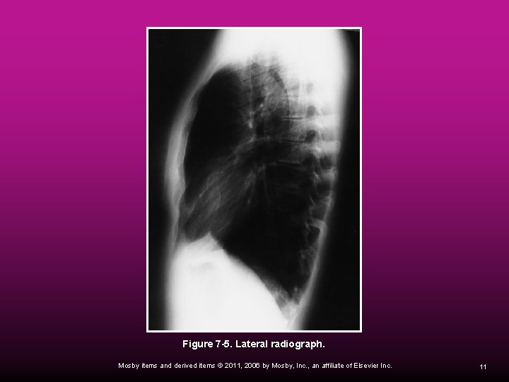  Figure 7 -5. Lateral radiograph. Mosby items and derived items © 2011, 2006