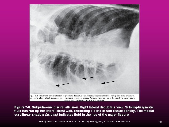 Figure 7 -6. Subpulmonic pleural effusion. Right lateral decubitus view. Subdiaphragmatic fluid has run