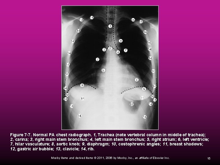  Figure 7 -7. Normal PA chest radiograph. 1, Trachea (note vertebral column in