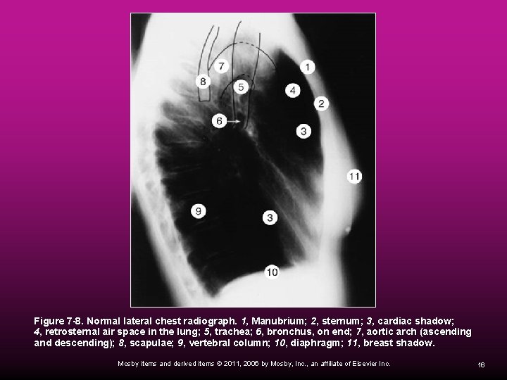  Figure 7 -8. Normal lateral chest radiograph. 1, Manubrium; 2, sternum; 3, cardiac