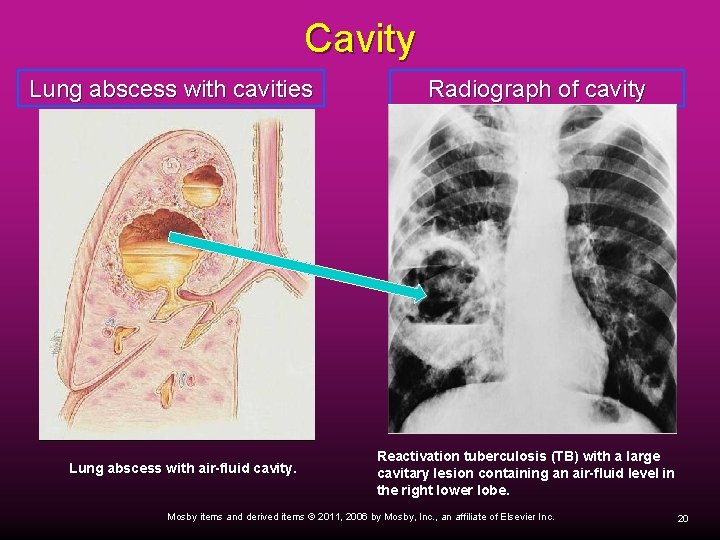 Cavity Lung abscess with cavities Lung abscess with air-fluid cavity. Radiograph of cavity Reactivation