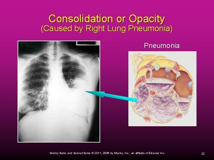 Consolidation or Opacity (Caused by Right Lung Pneumonia) Pneumonia Mosby items and derived items