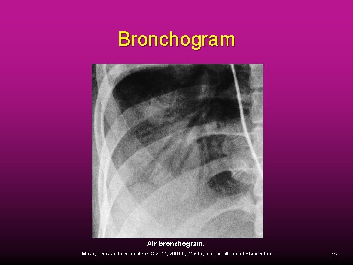 Bronchogram Air bronchogram. Mosby items and derived items © 2011, 2006 by Mosby, Inc.