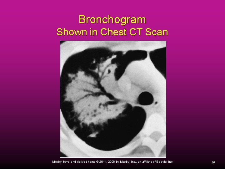 Bronchogram Shown in Chest CT Scan Mosby items and derived items © 2011, 2006