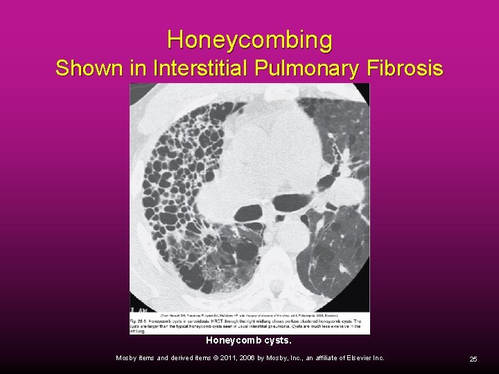 Honeycombing Shown in Interstitial Pulmonary Fibrosis Honeycomb cysts. Mosby items and derived items ©
