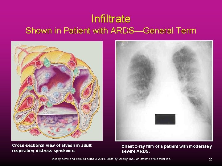 Infiltrate Shown in Patient with ARDS—General Term Cross-sectional view of alveoli in adult respiratory