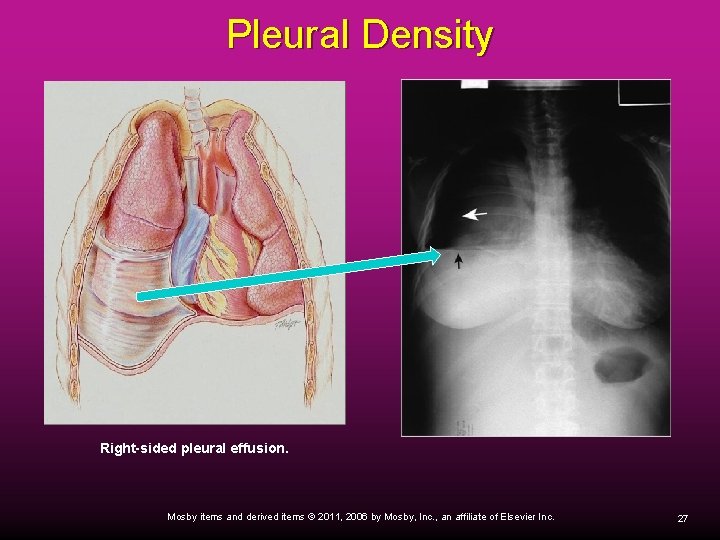 Pleural Density Right-sided pleural effusion. Mosby items and derived items © 2011, 2006 by