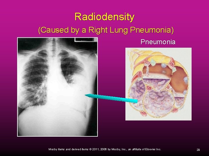 Radiodensity (Caused by a Right Lung Pneumonia) Pneumonia Mosby items and derived items ©