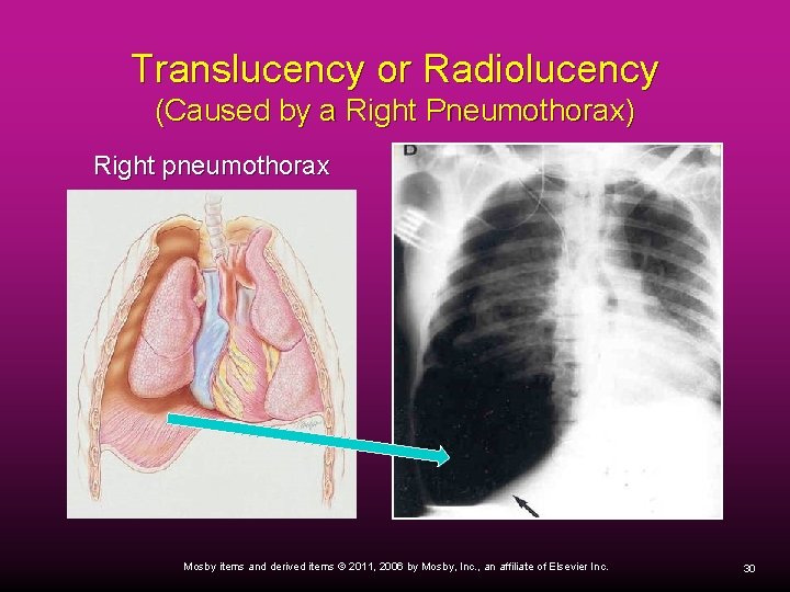 Translucency or Radiolucency (Caused by a Right Pneumothorax) Right pneumothorax Mosby items and derived