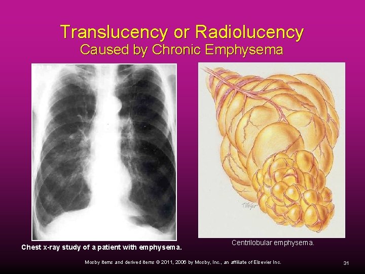 Translucency or Radiolucency Caused by Chronic Emphysema Chest x-ray study of a patient with
