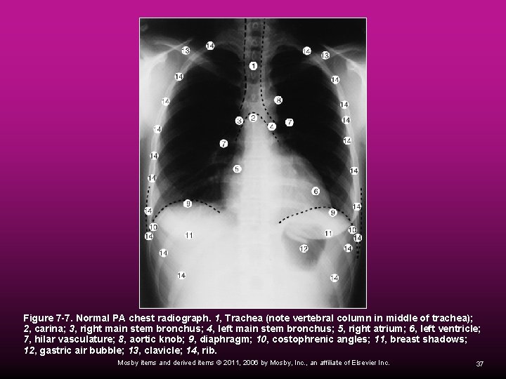 Figure 7 -7. Normal PA chest radiograph. 1, Trachea (note vertebral column in middle